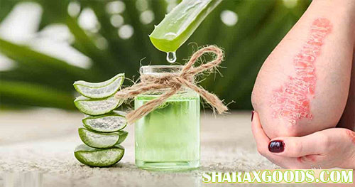 کاربرد آلوورا در درمان اگزما